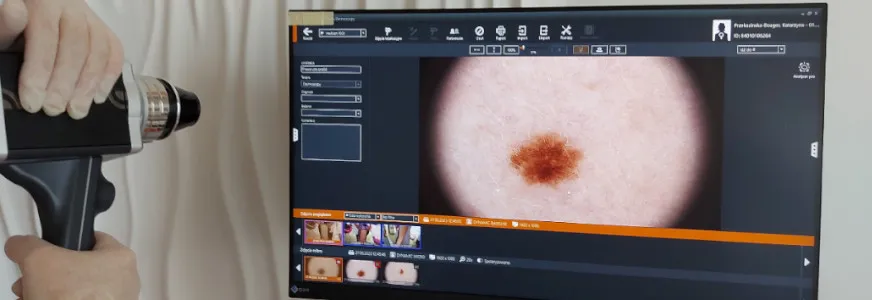 Videodermatoskopia badanie znamion wideodermatoskopem cyfrowym