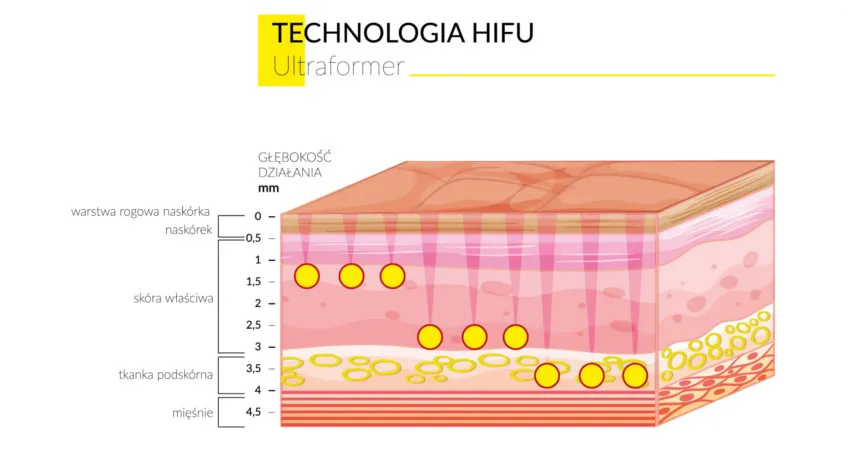 Ultraformer III HIFU modelowanie ciała