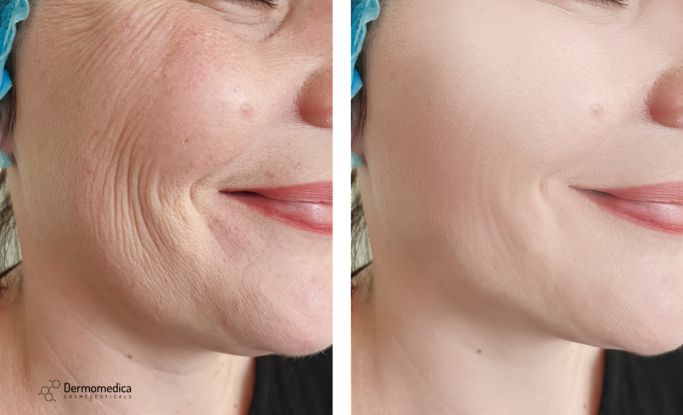 Морщинки на водной. Убрать морщины. Face Wrinkles before after. Морщины до после в профиль. Морщины до после Сток.