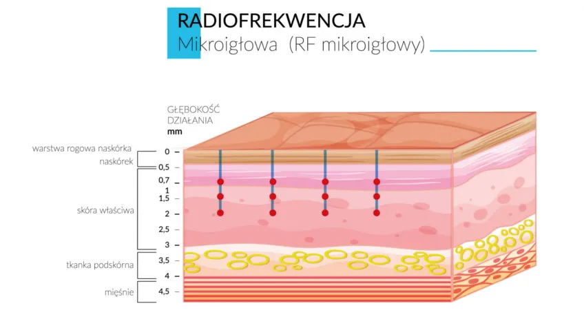 RF radiofrekwencja mikroigłowa fala radiowa