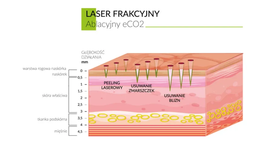 Laserowe usuwanie zmarszczek i blizn - laser frakcyjny CO2