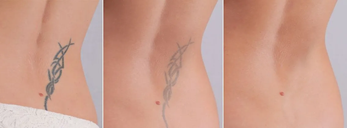 Usuwanie tatuaży za pomocą lasera nanosekundowego Helios III